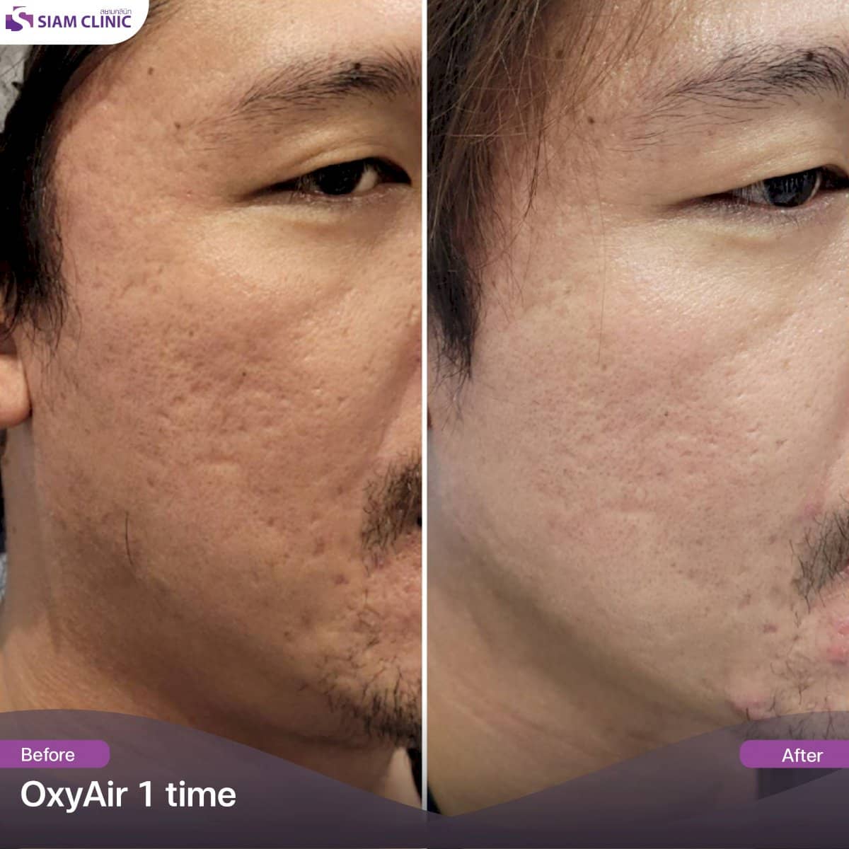 Case 19437 - acne scar treatment