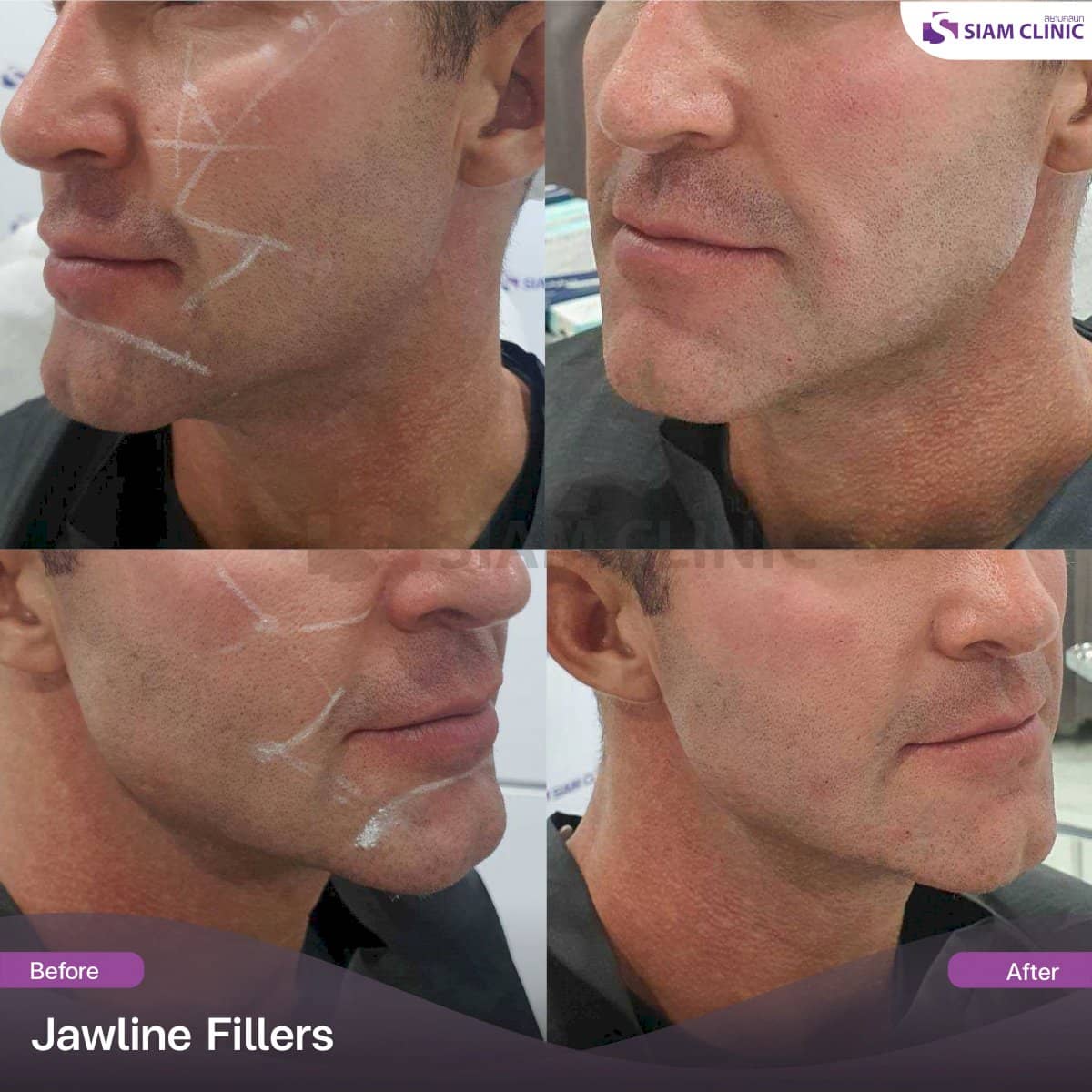 Case 19440 - jawline fillers