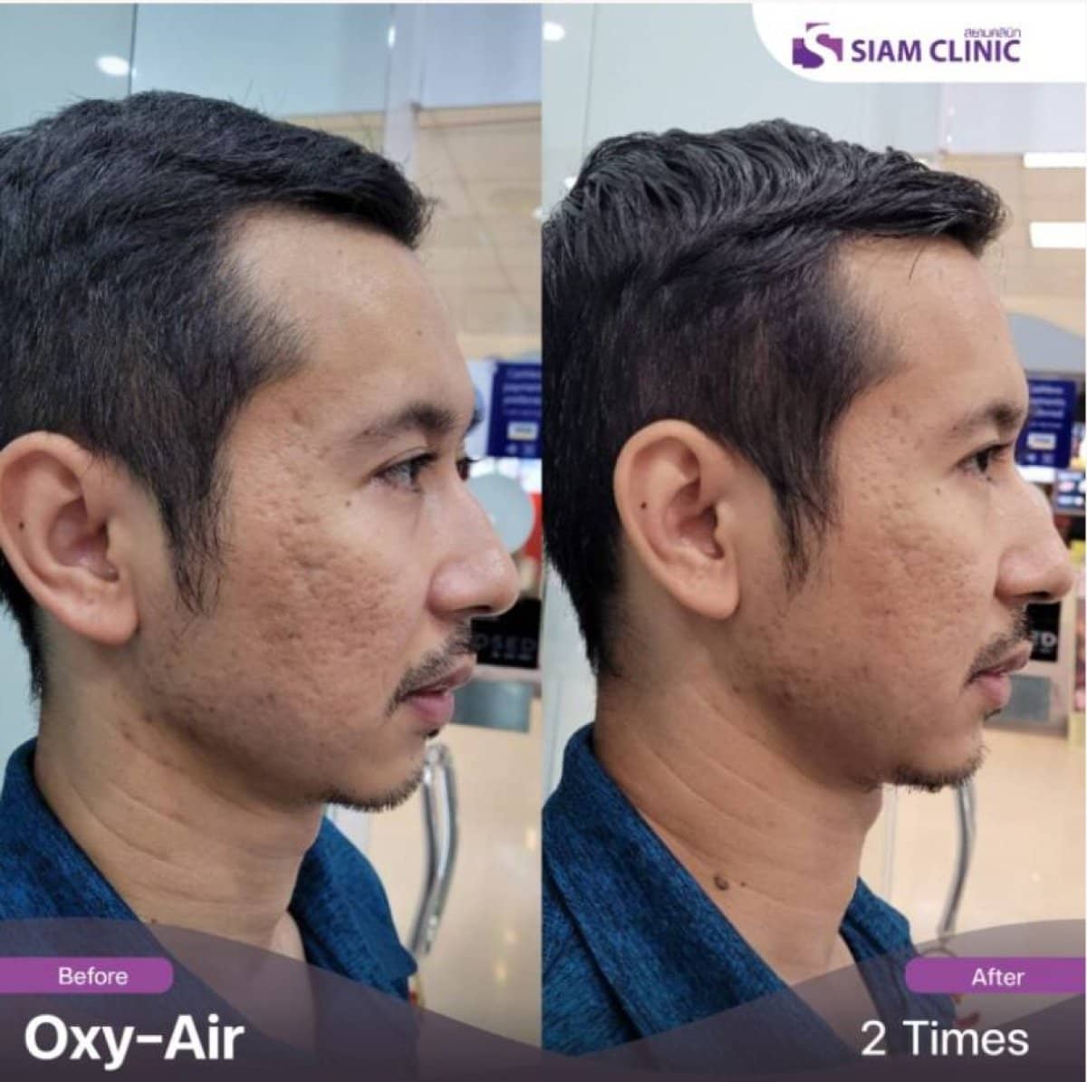 Case 19453 - acne scar treatment