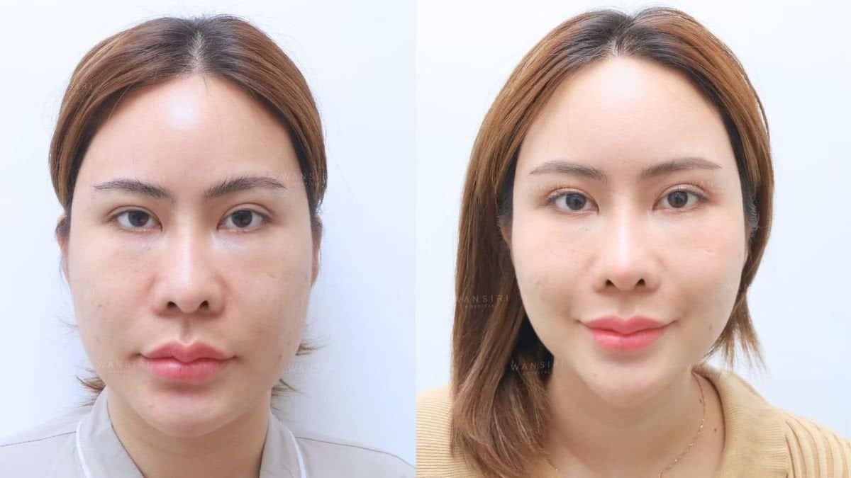 Case 19459 - stem cell therapy facial rejuvenation