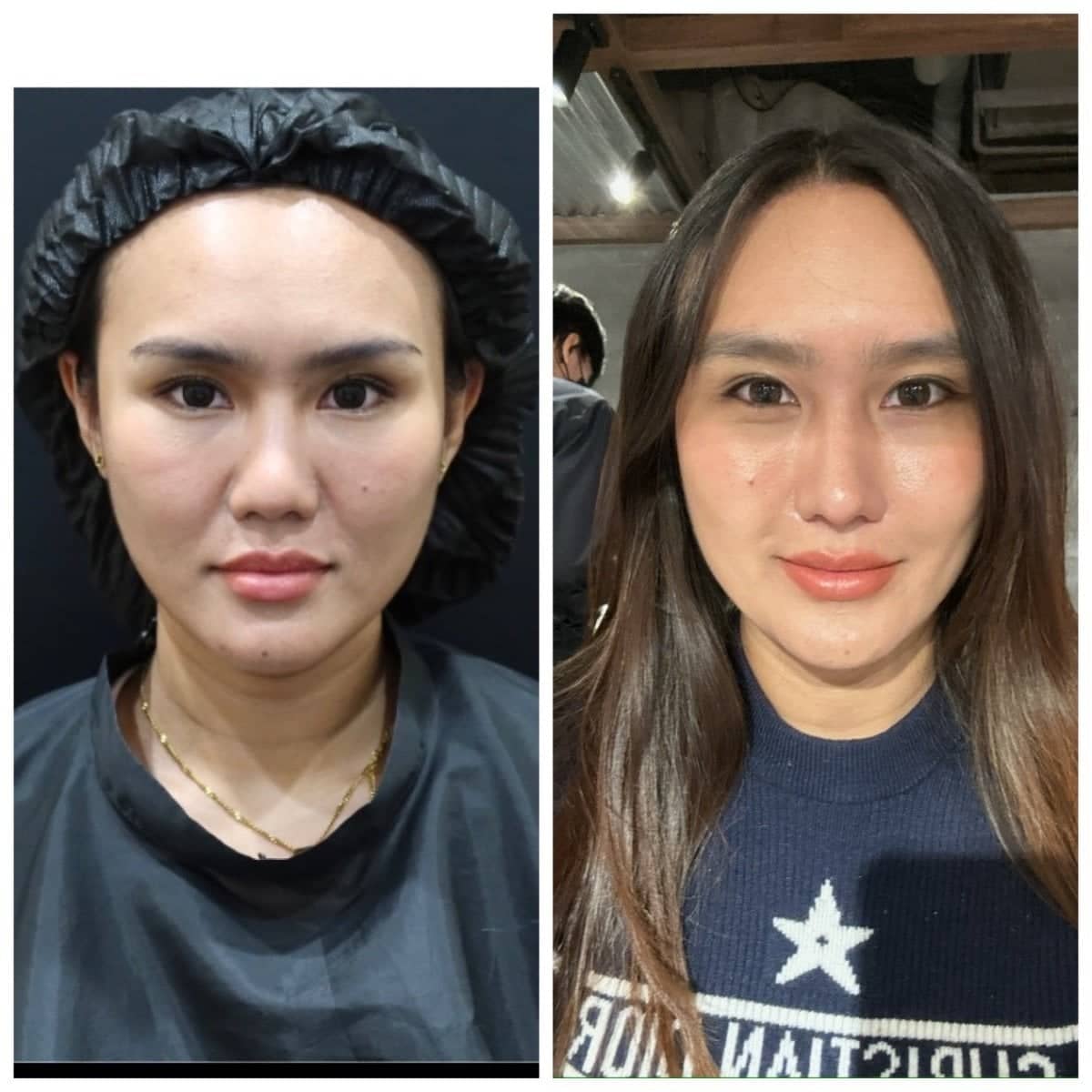 Case 19463 - stem cell therapy facial rejuvenation