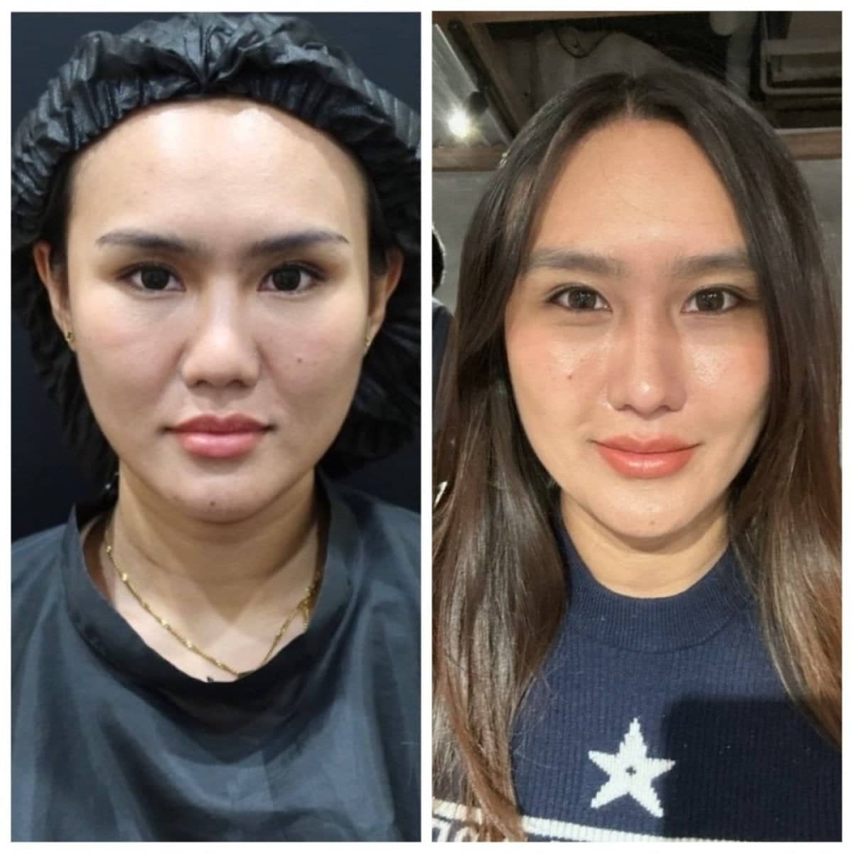 Case 19464 - stem cell therapy facial rejuvenation