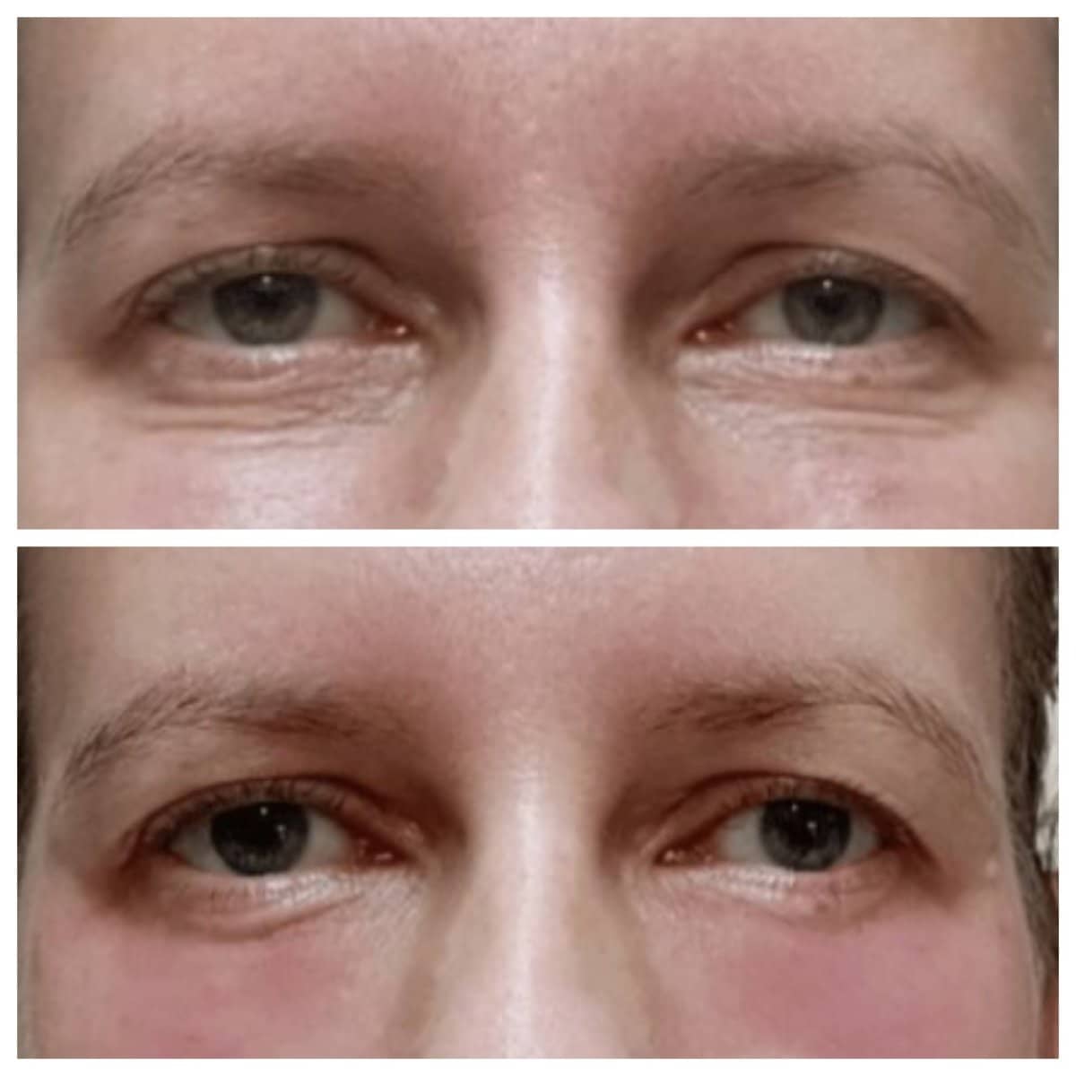 Case 19470 - fillers injection under eyes