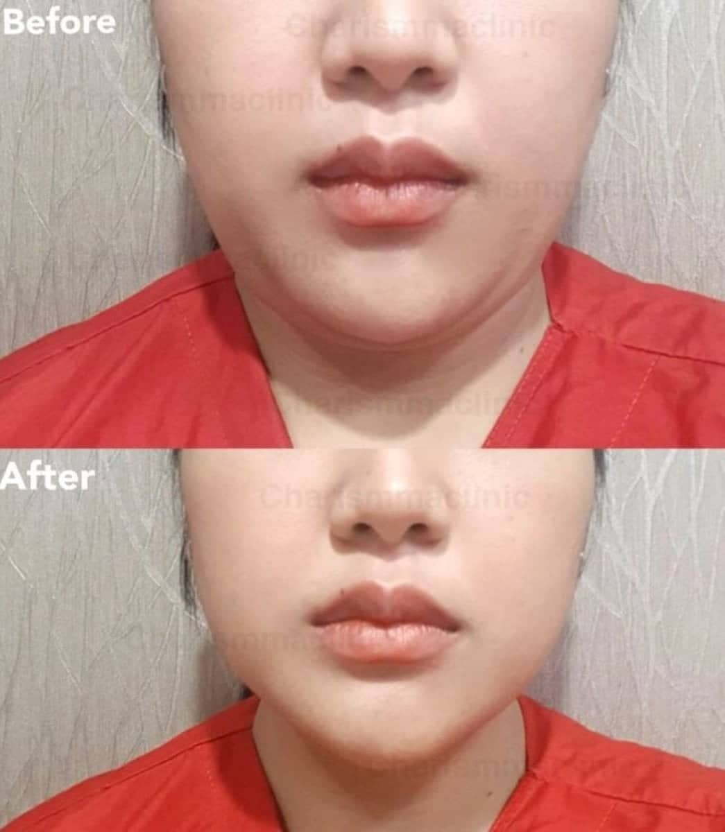 Case 19471 - chin liposuction