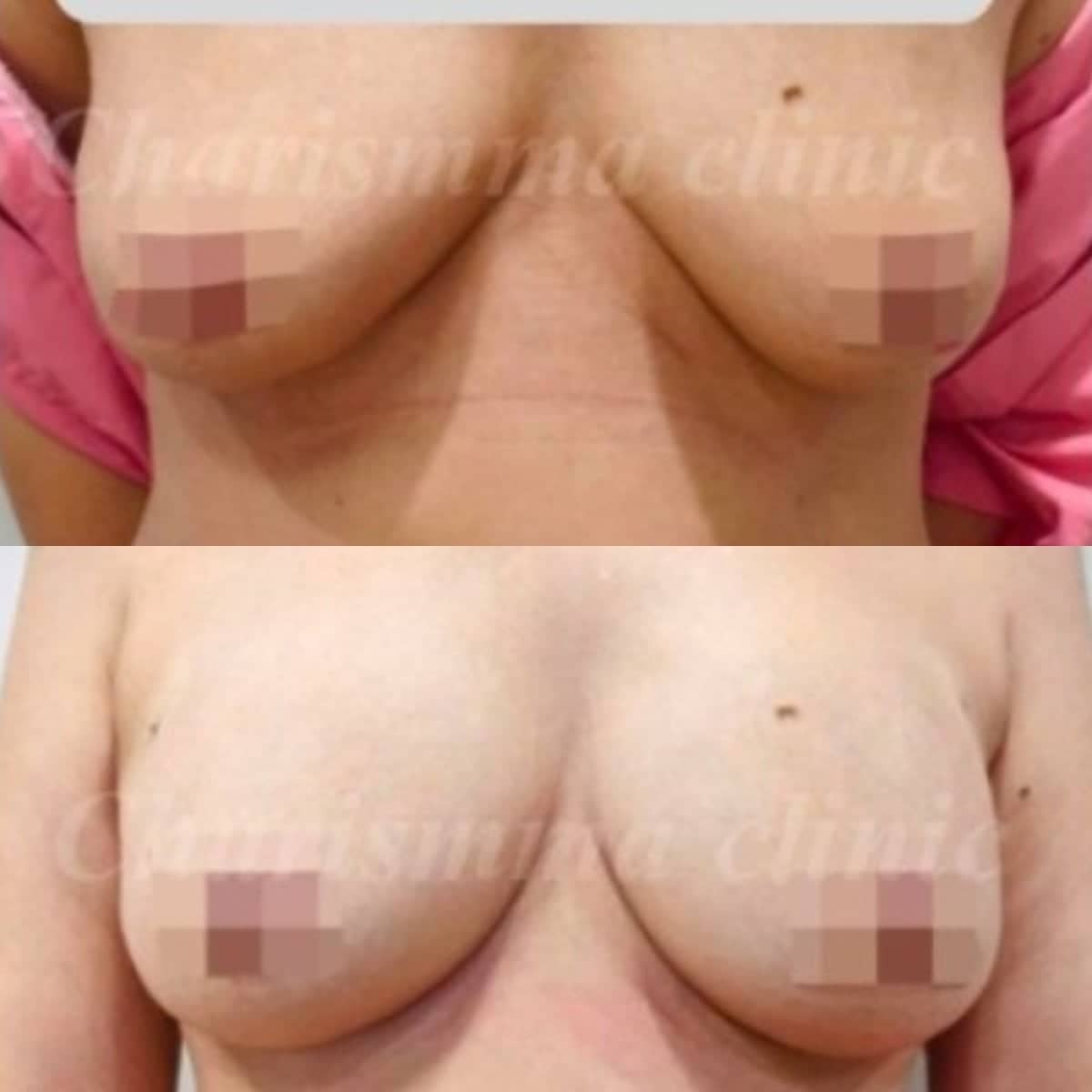 Case 19472 - breast augmentation