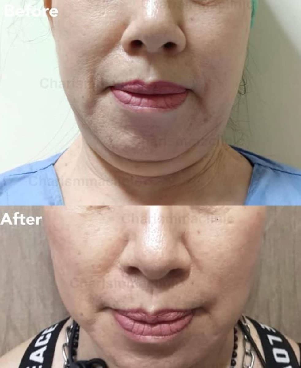 Case 19474 - chin liposuction