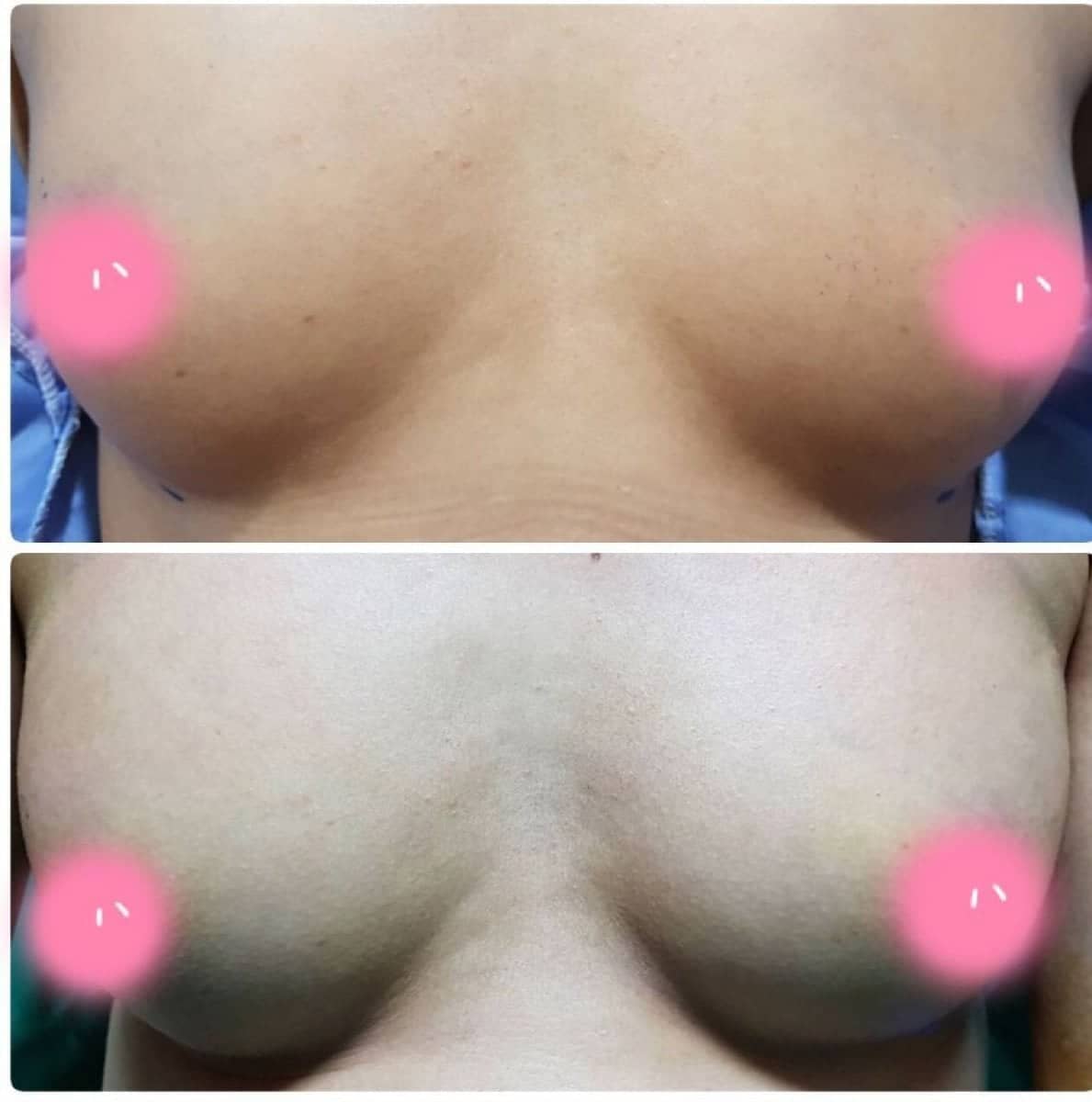 Case 19477 - breast augmentation