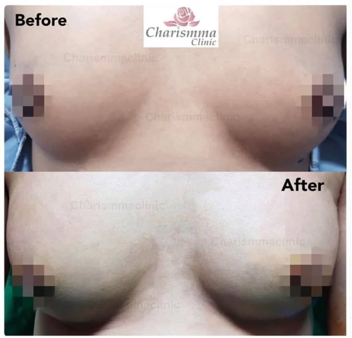 Case 19478 - breast augmentation