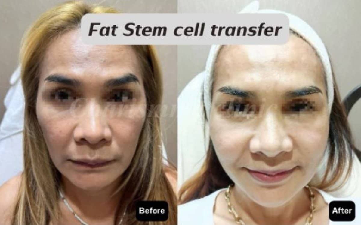 Case 19479 - facial fat transfer