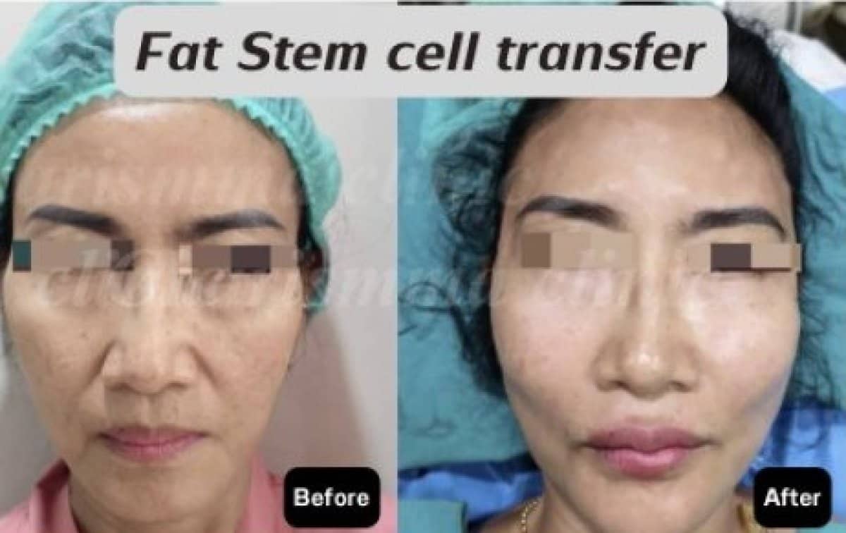 Case 19481 - facial fat transfer