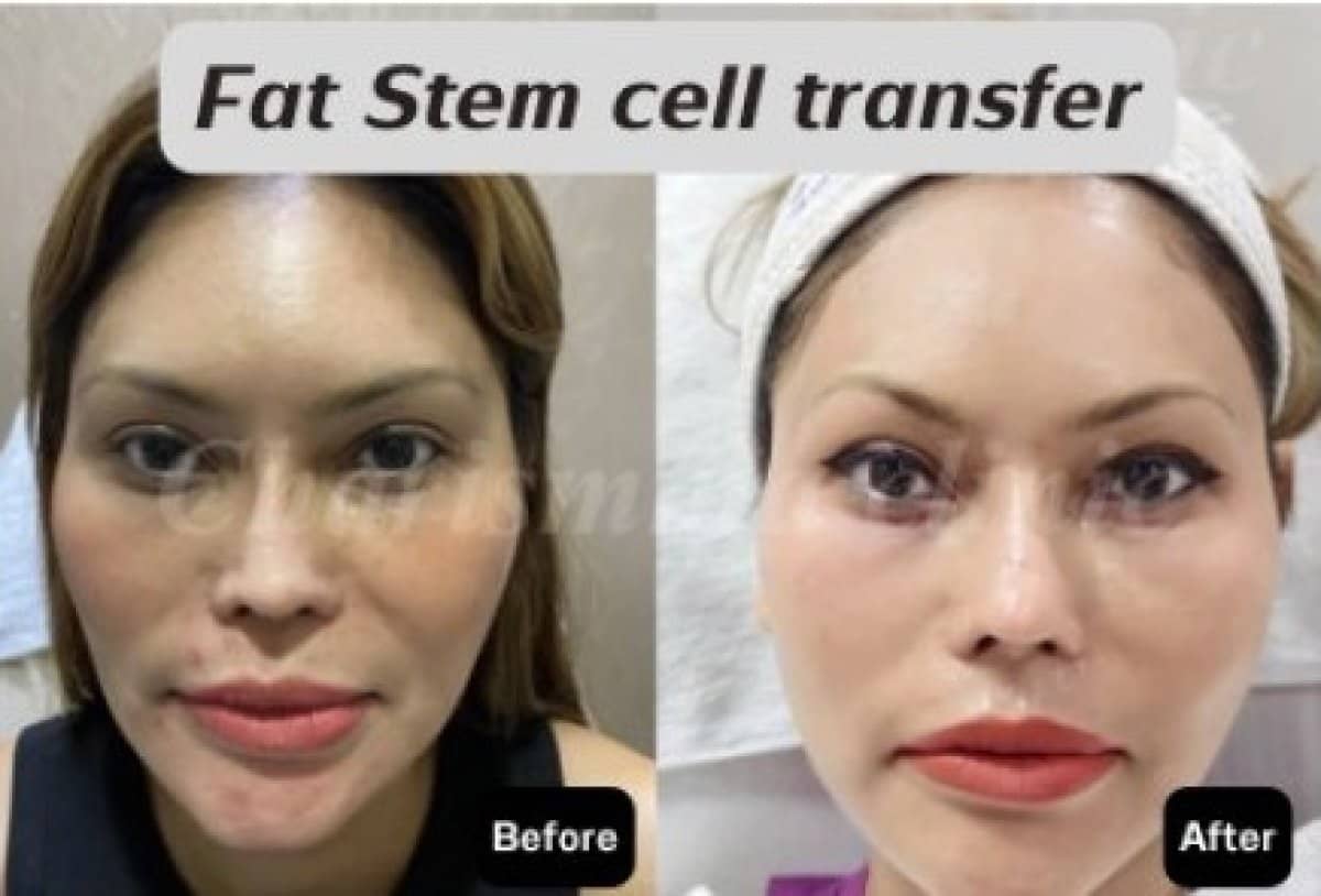 Case 19482 - facial fat stem cell transfer