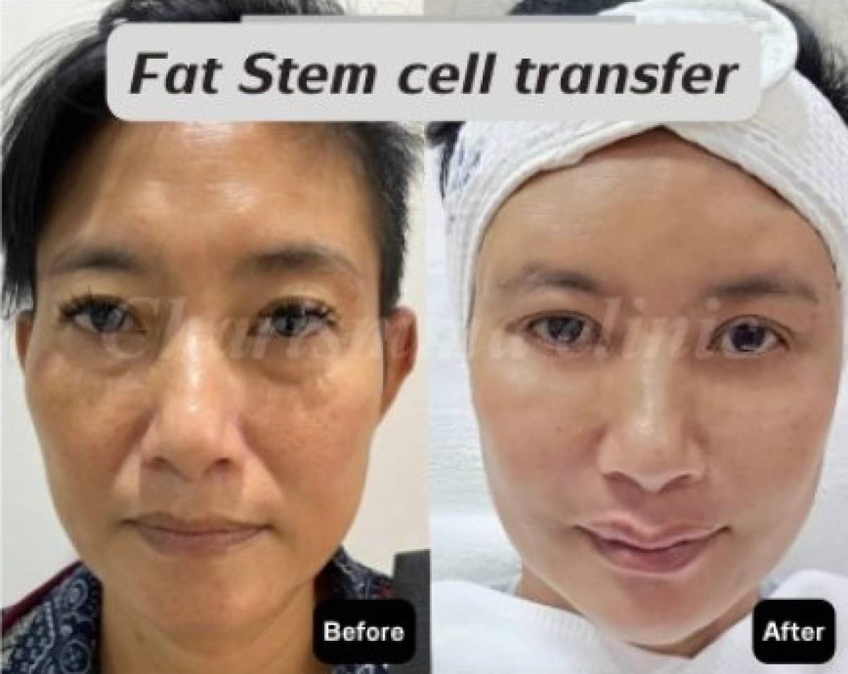 Case 19483 - facial fat transfer