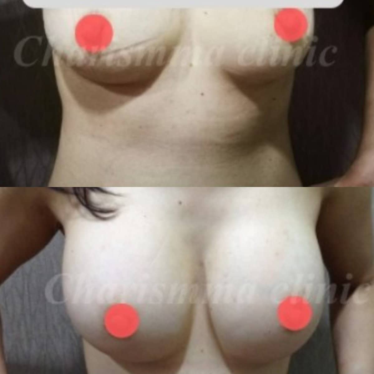 Case 19485 - breast augmentation