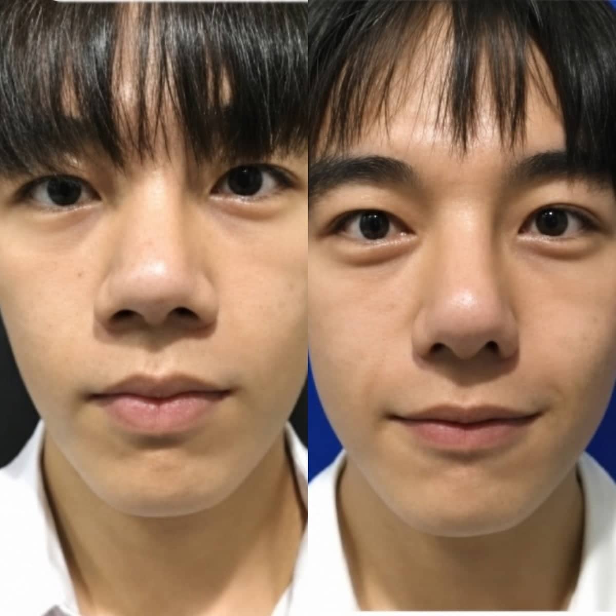 Case 19486 - open rhinoplasty