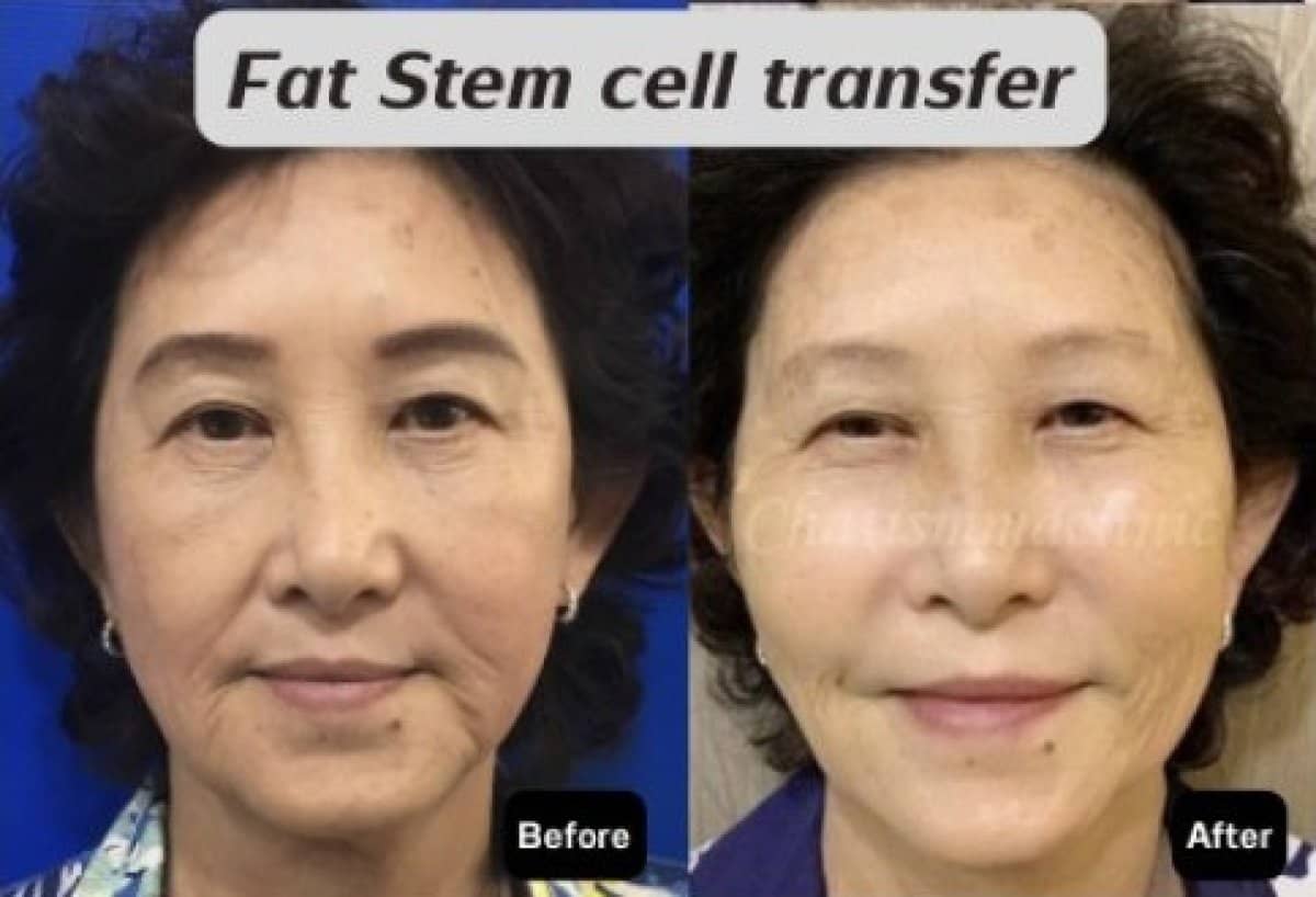 Case 19487 - facial fat transfer