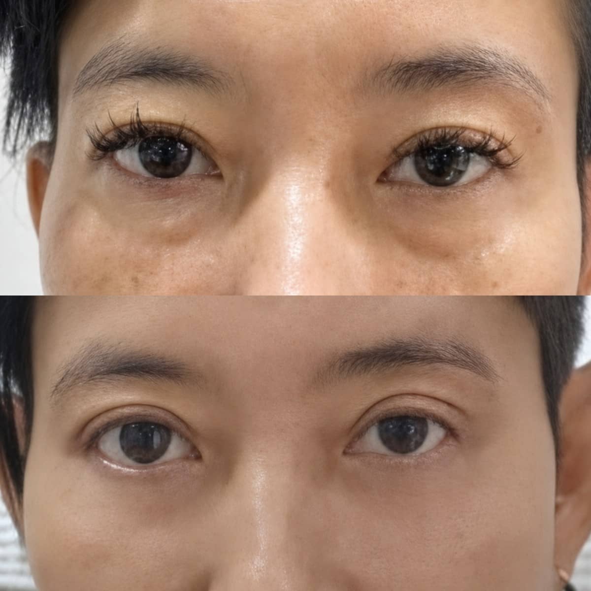 Case 19488 - upper and lower eyelid surgery