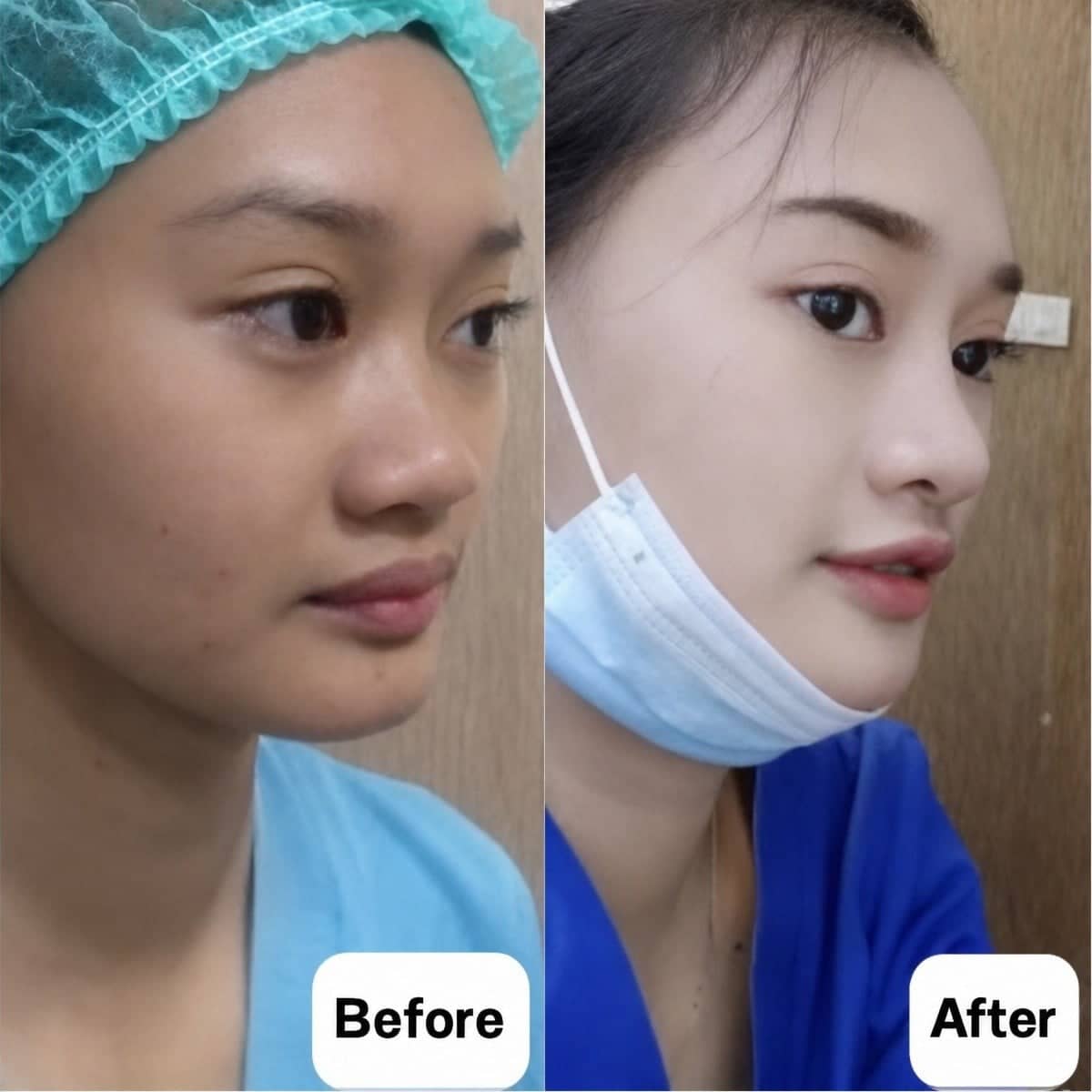 Case 19489 - rhinoplasty