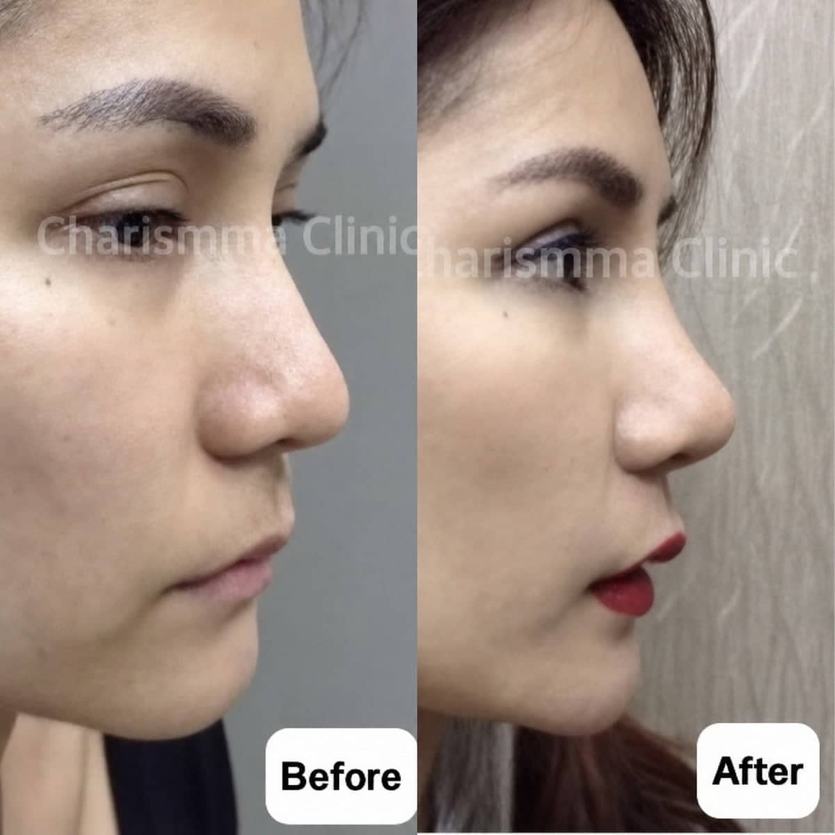 Case 19491 - open rhinoplasty