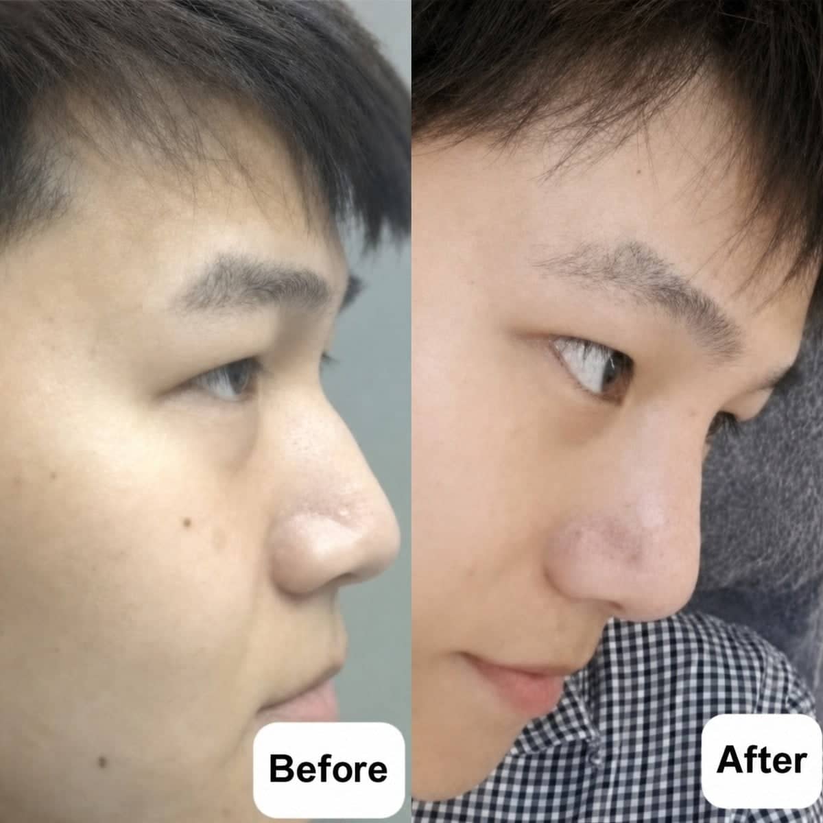 Case 19493 - open rhinoplasty