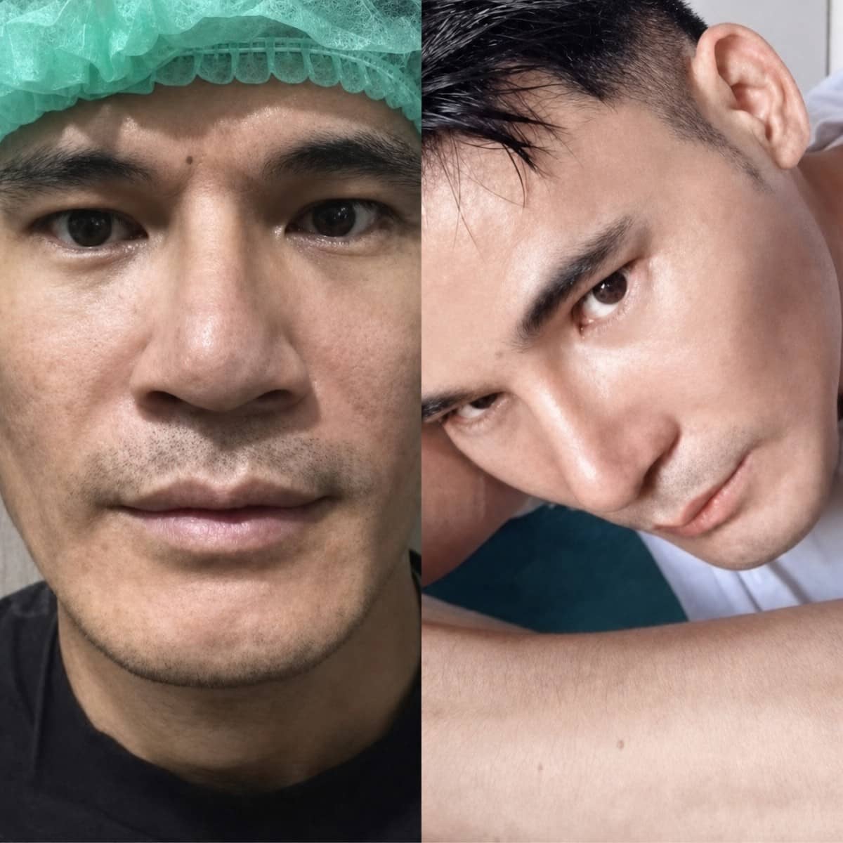 Case 19496 - open rhinoplasty