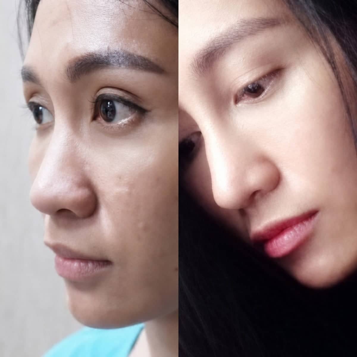 Case 19497 - rhinoplasty