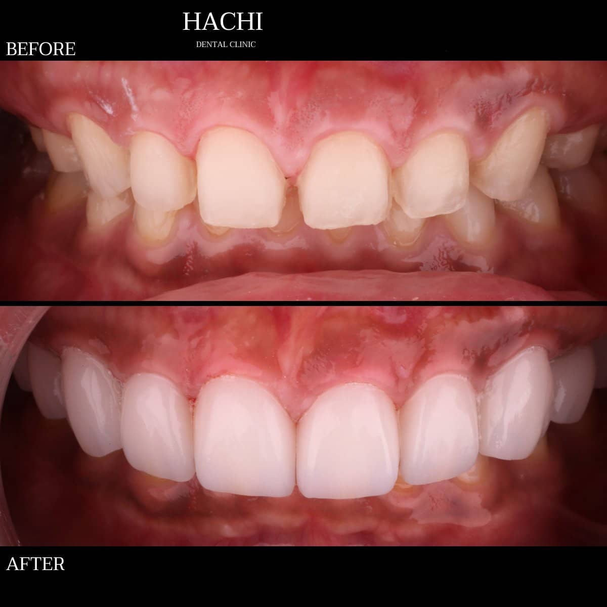 Case 19502 - dental veneers