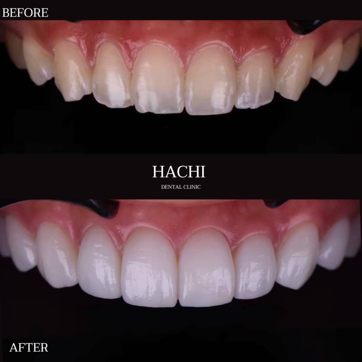 Case 19504 - dental veneers