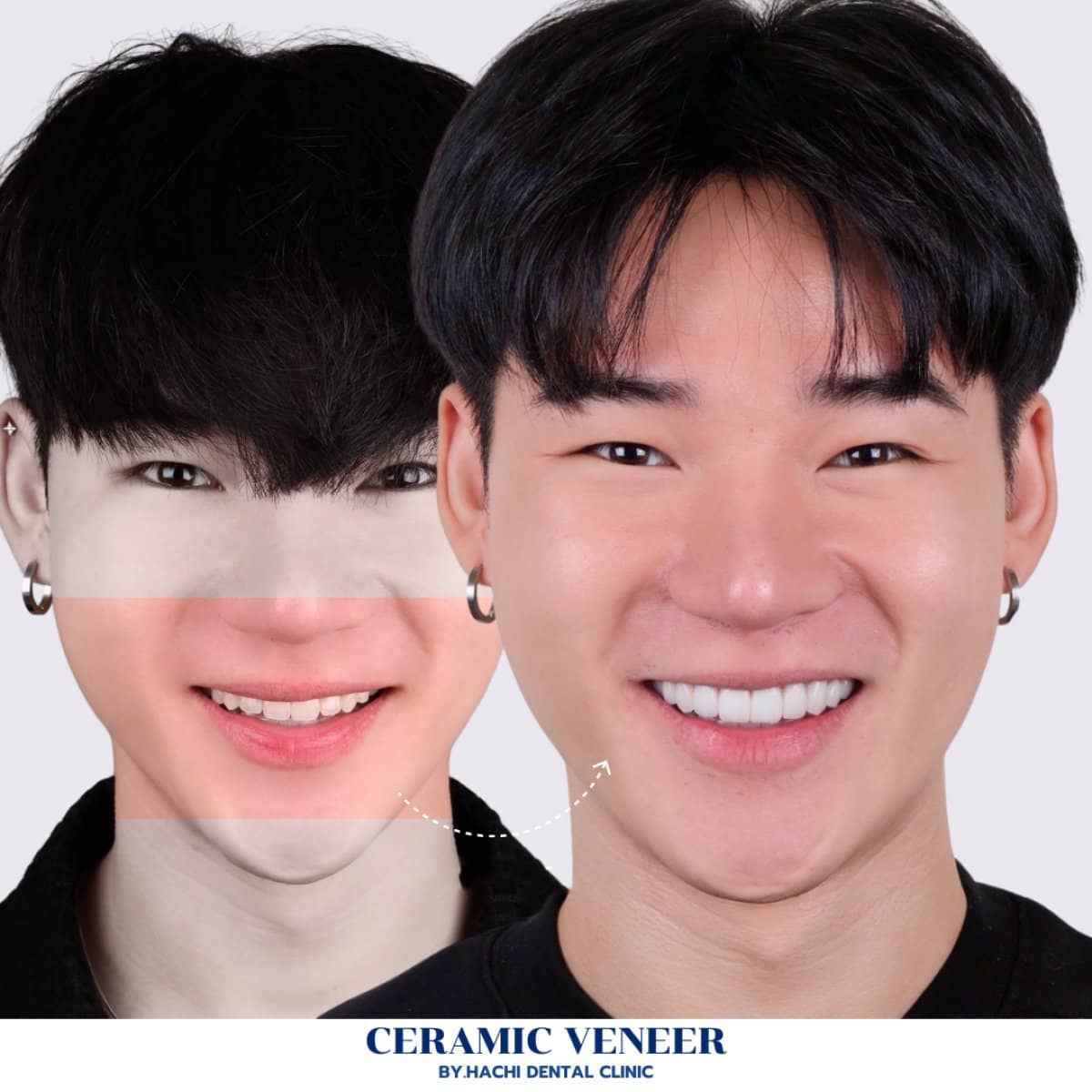 Case 19505 - ceramic veneers