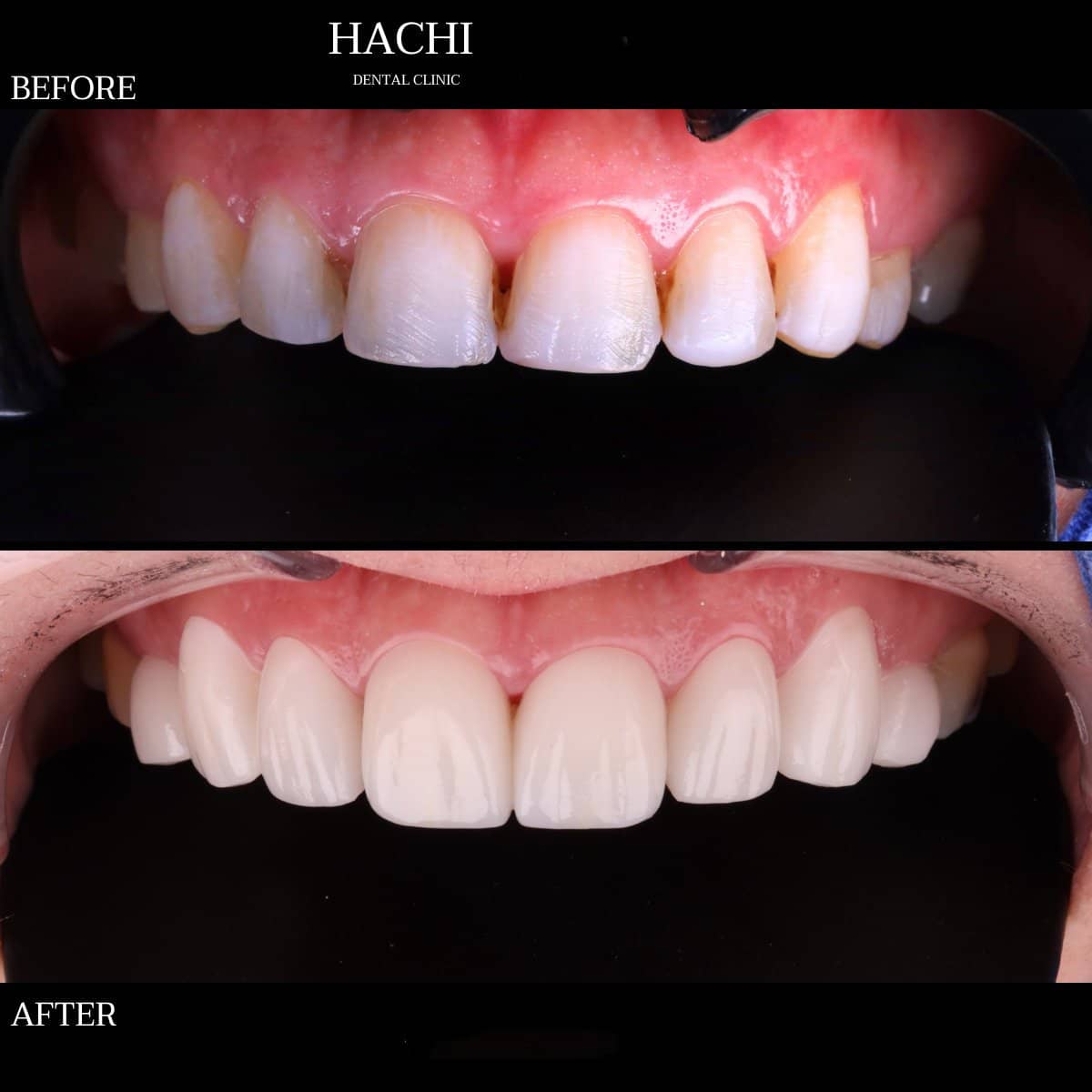 Case 19508 - dental veneers
