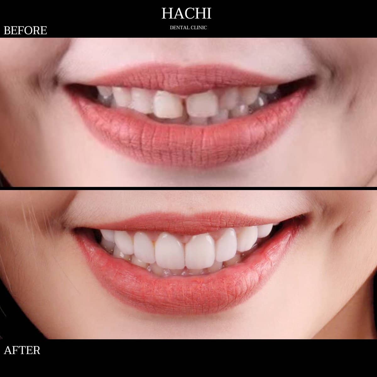 Case 19509 - veneers