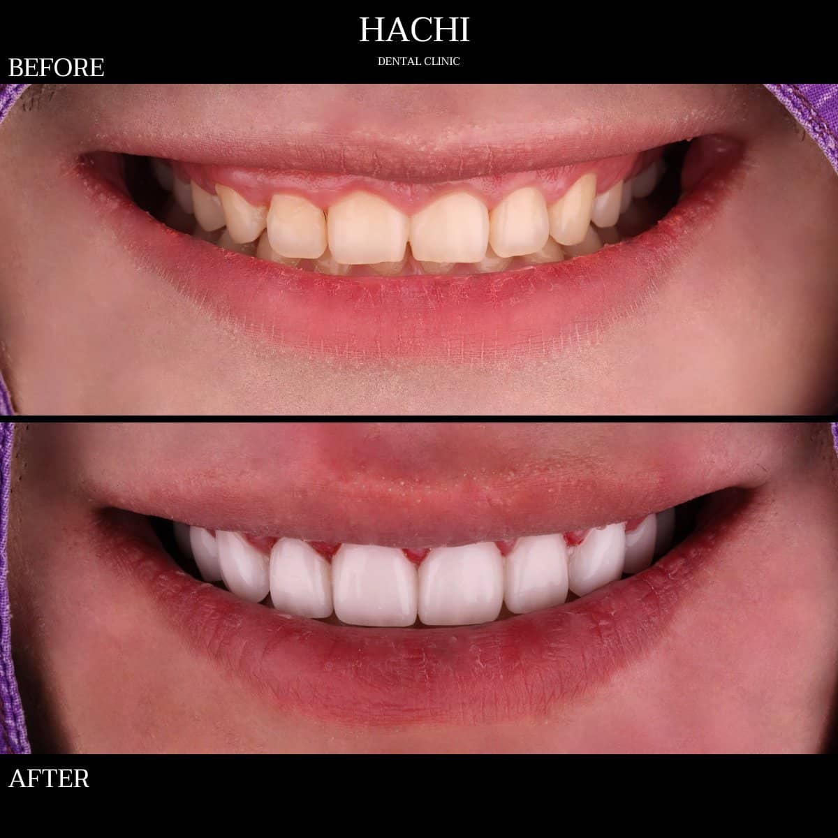 Case 19510 - dental veneers