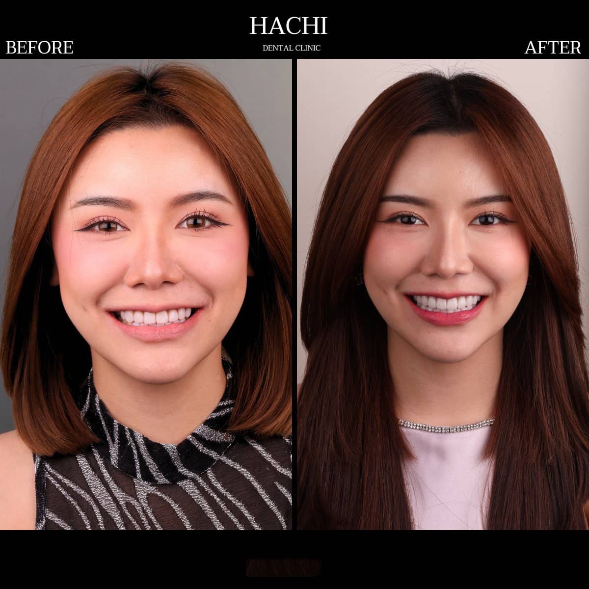 Case 19511 - dental veneers