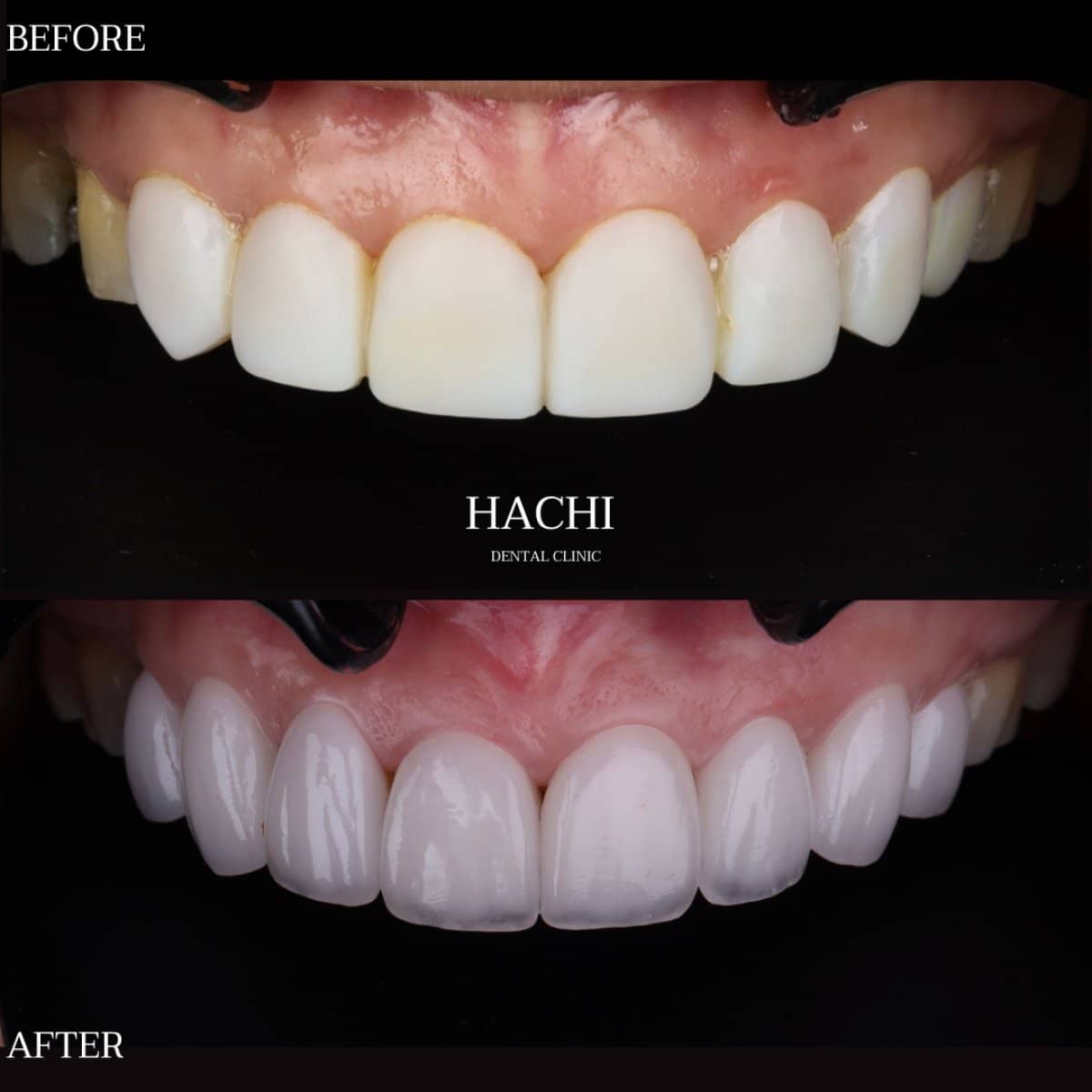 Case 19512 - veneers