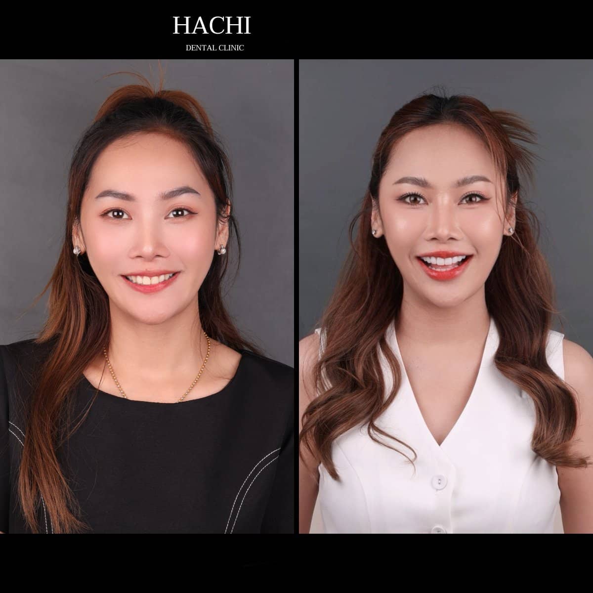 Case 19516 - veneers