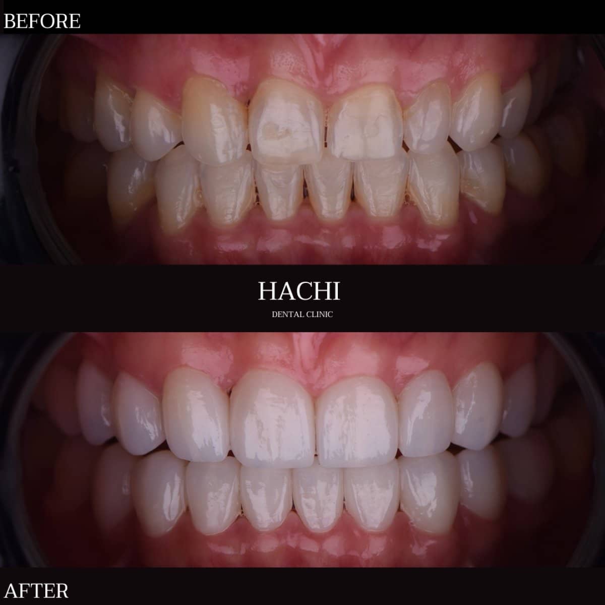 Case 19517 - dental veneers