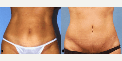Case 1952 - Woman treated with Tummy Tuck