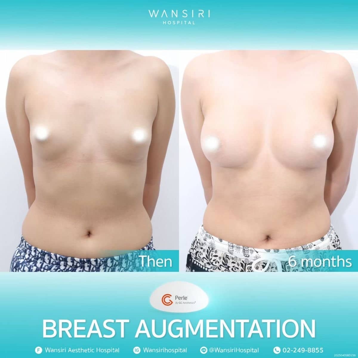 Case 19523 - breast augmentation