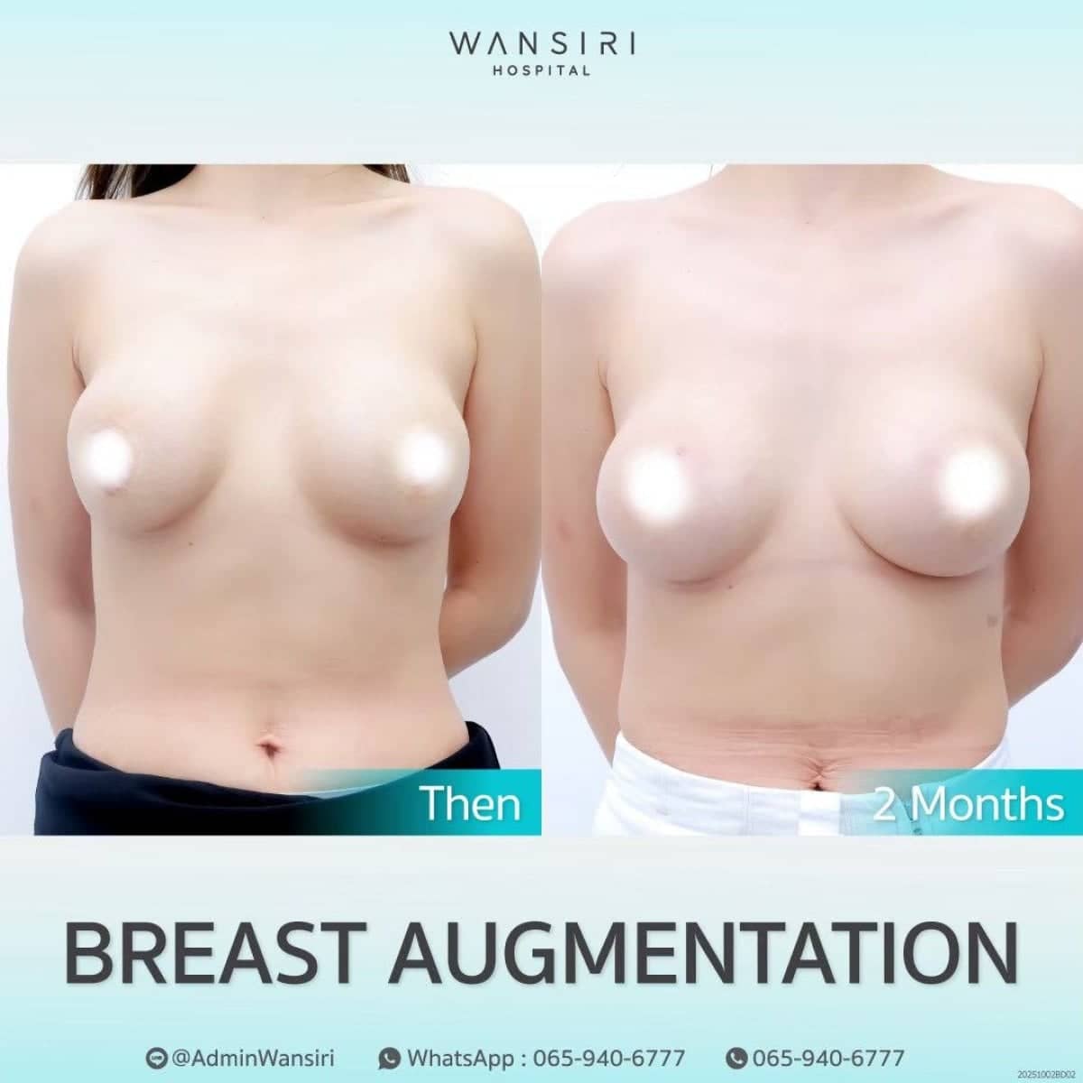 Case 19524 - breast augmentation