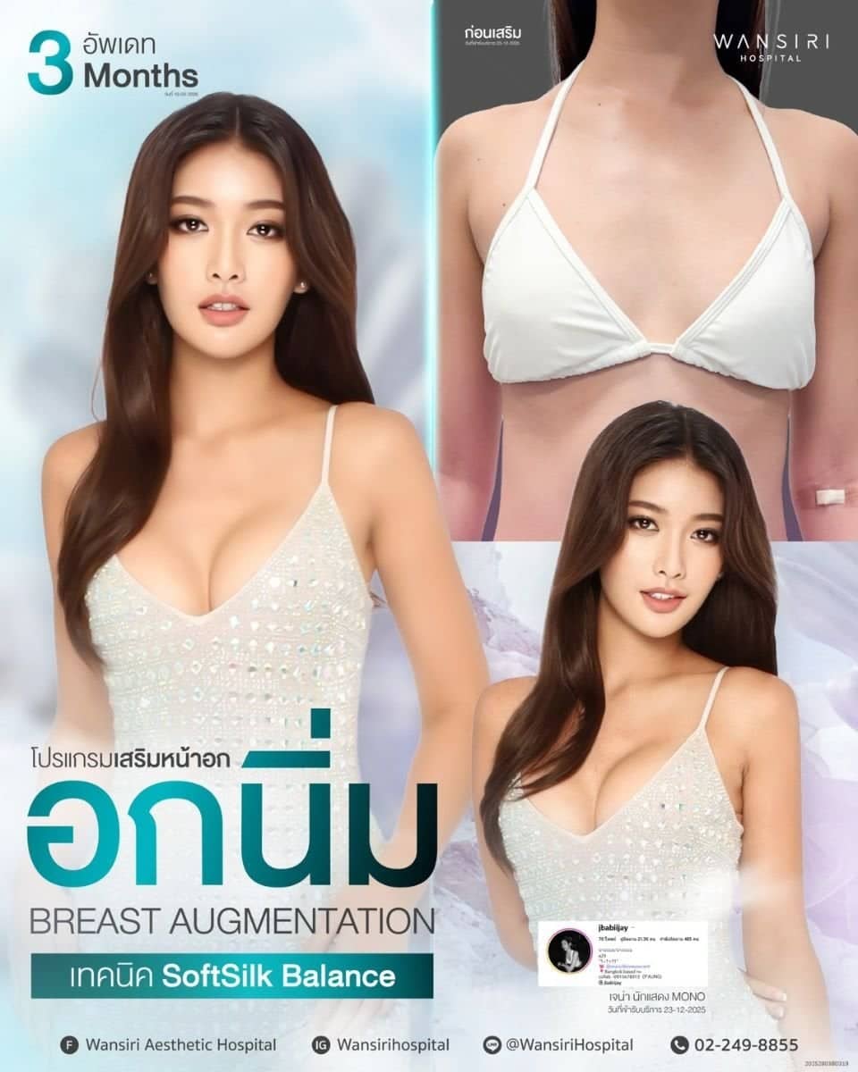 Case 19527 - breast augmentation