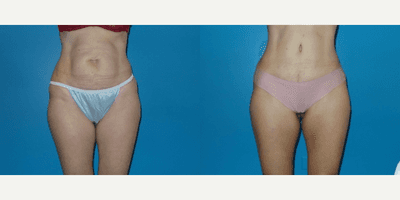 Case 1953 - Woman treated with Tummy Tuck