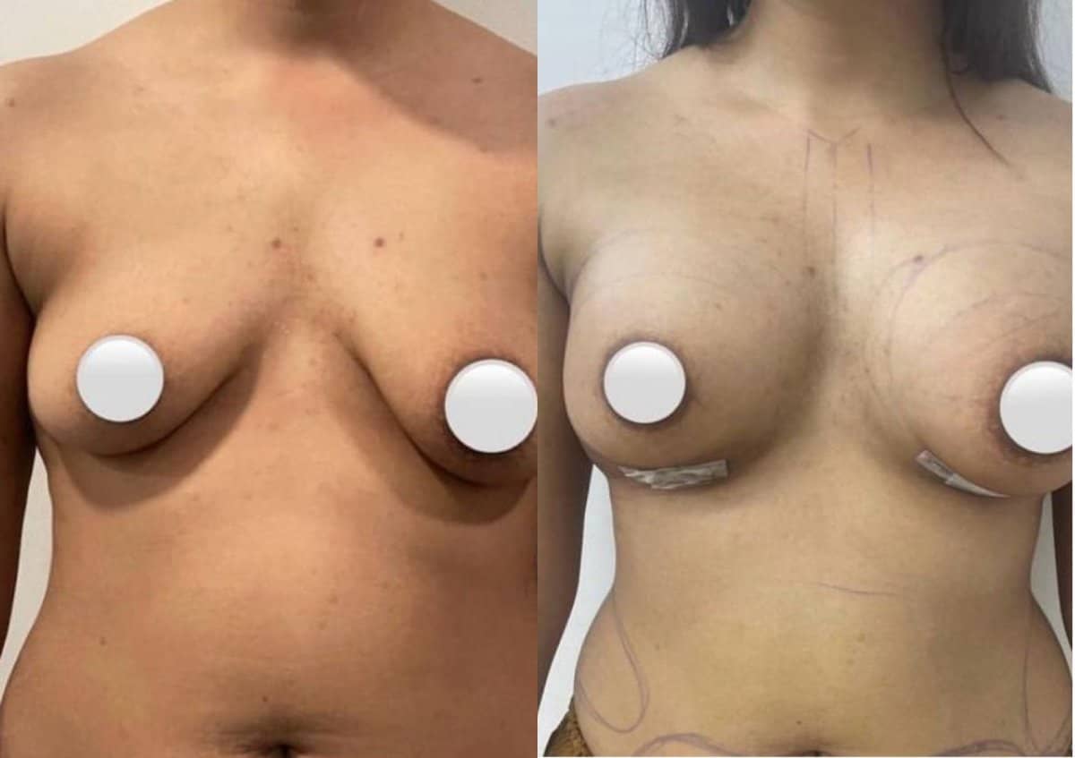 Case 19547 - breast augmentation