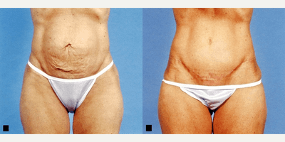 Case 1955 - Woman treated with Tummy Tuck
