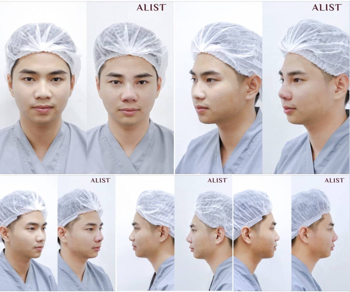 Case 19551 - rhinoplasty