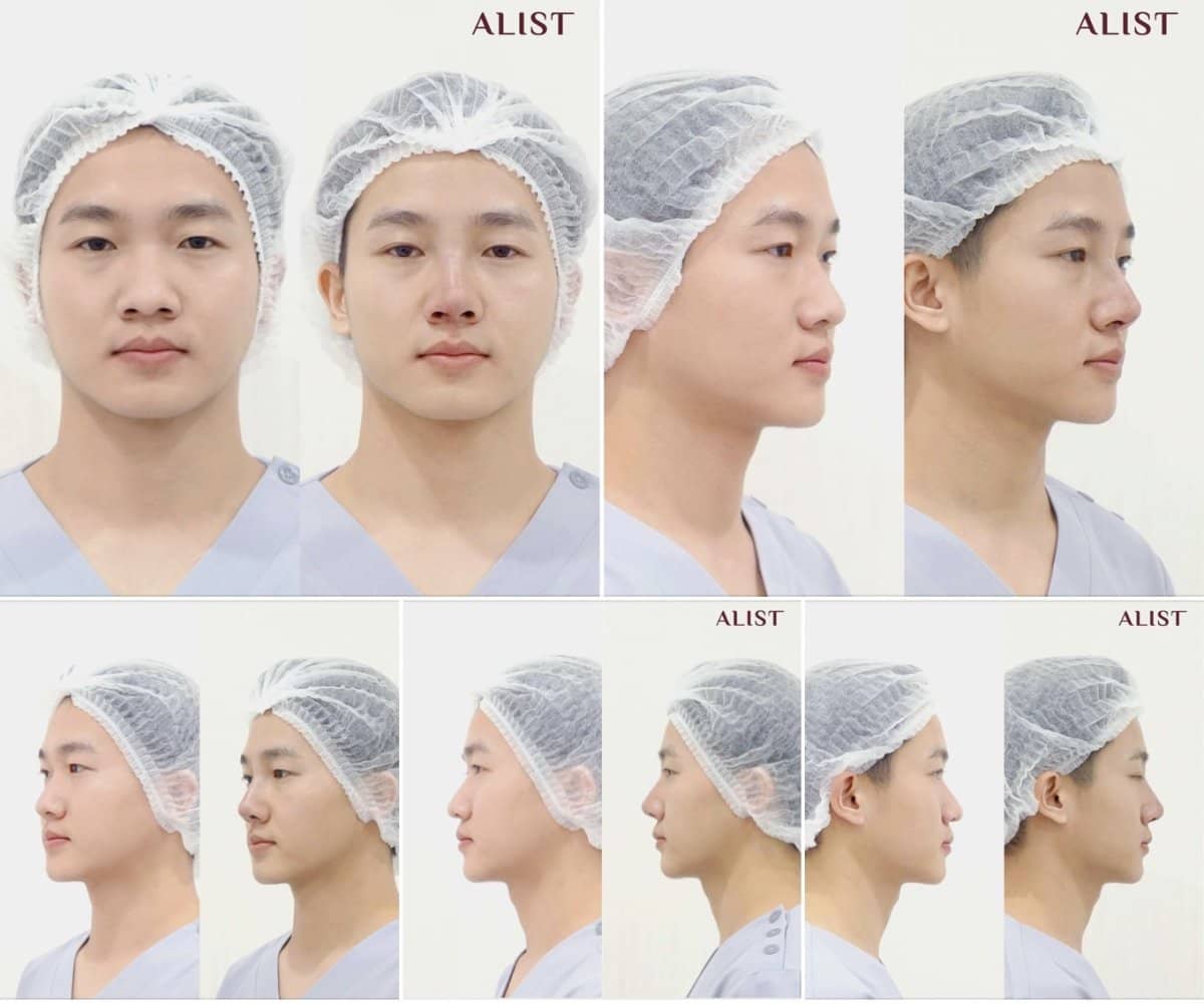 Case 19552 - rhinoplasty