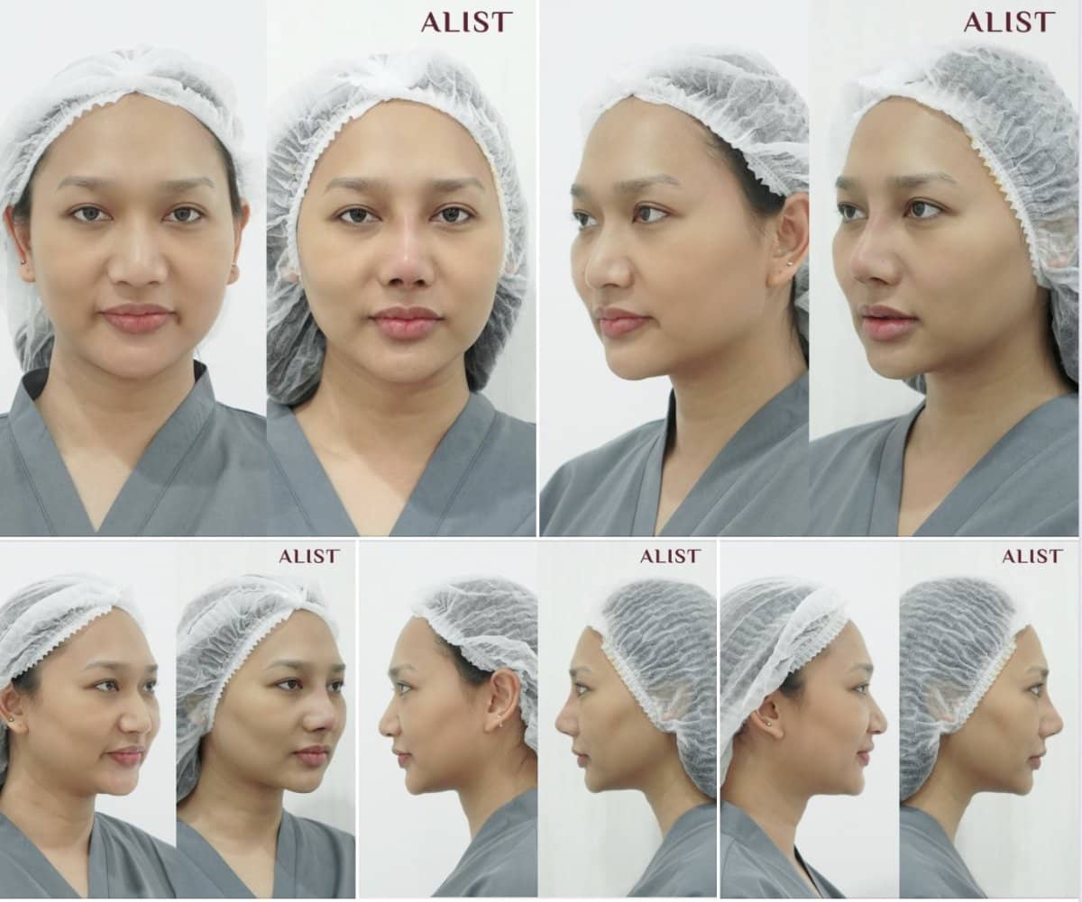 Case 19553 - rhinoplasty