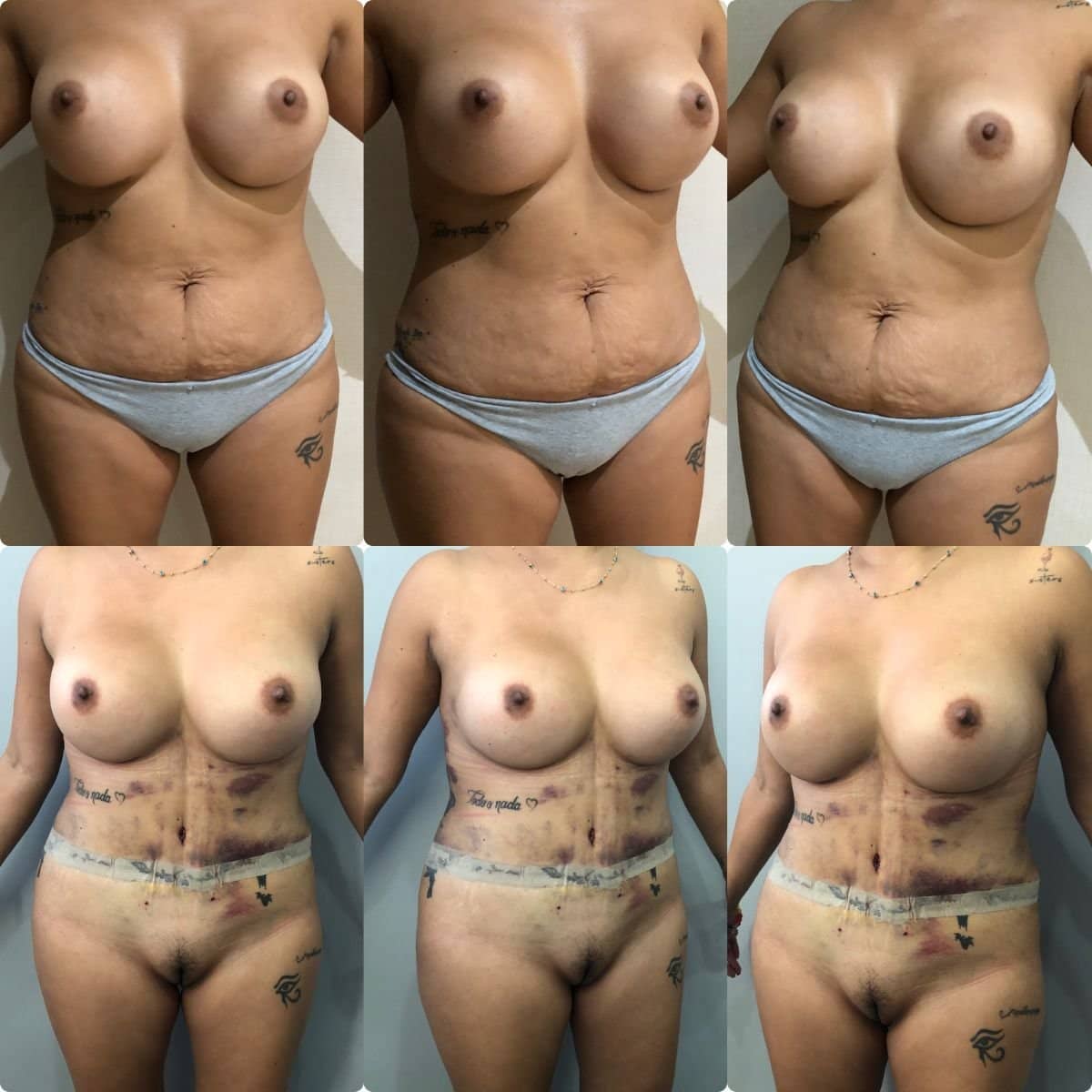 Case 19580 - breast lift and tummy tuck