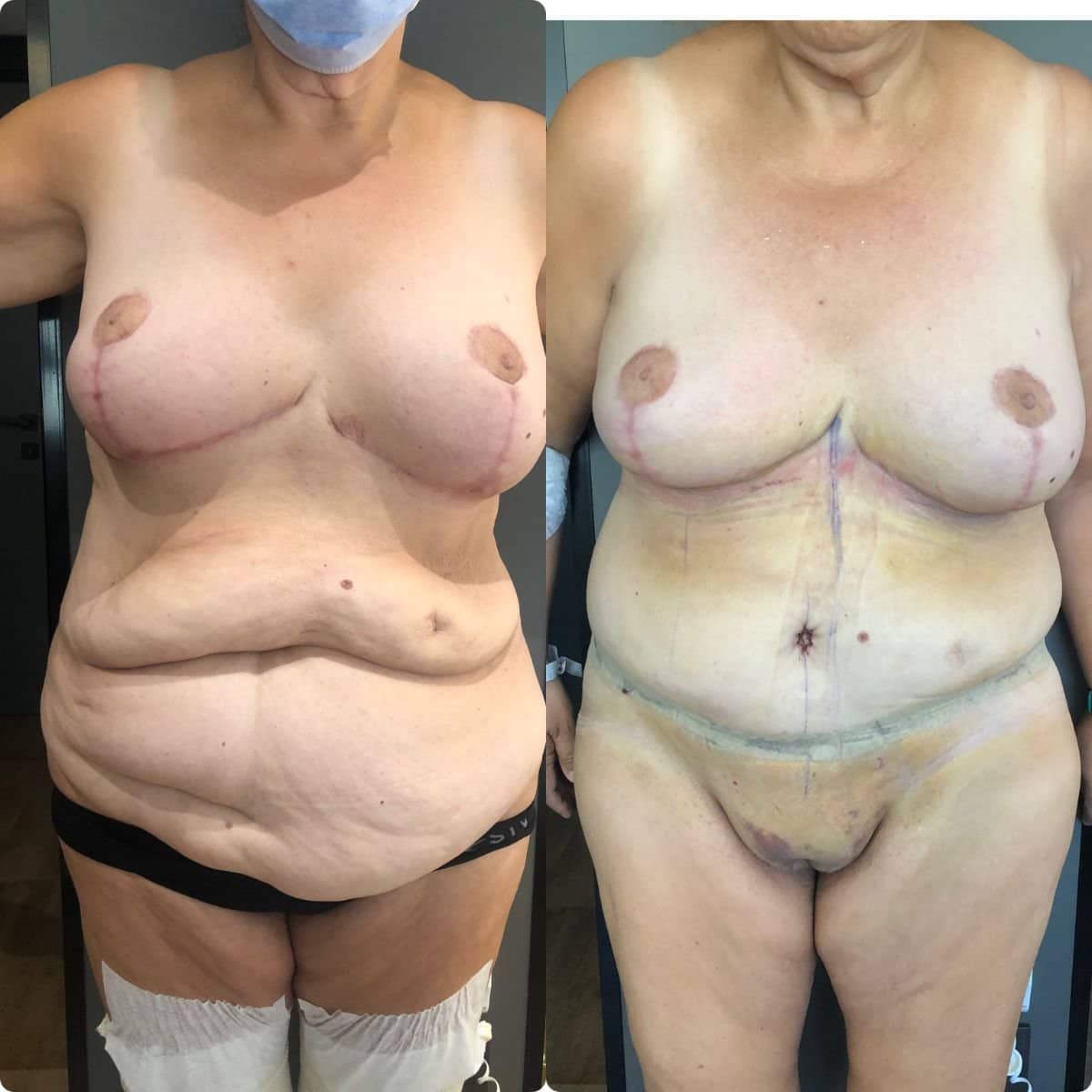 Case 19581 - breast lift and tummy tuck