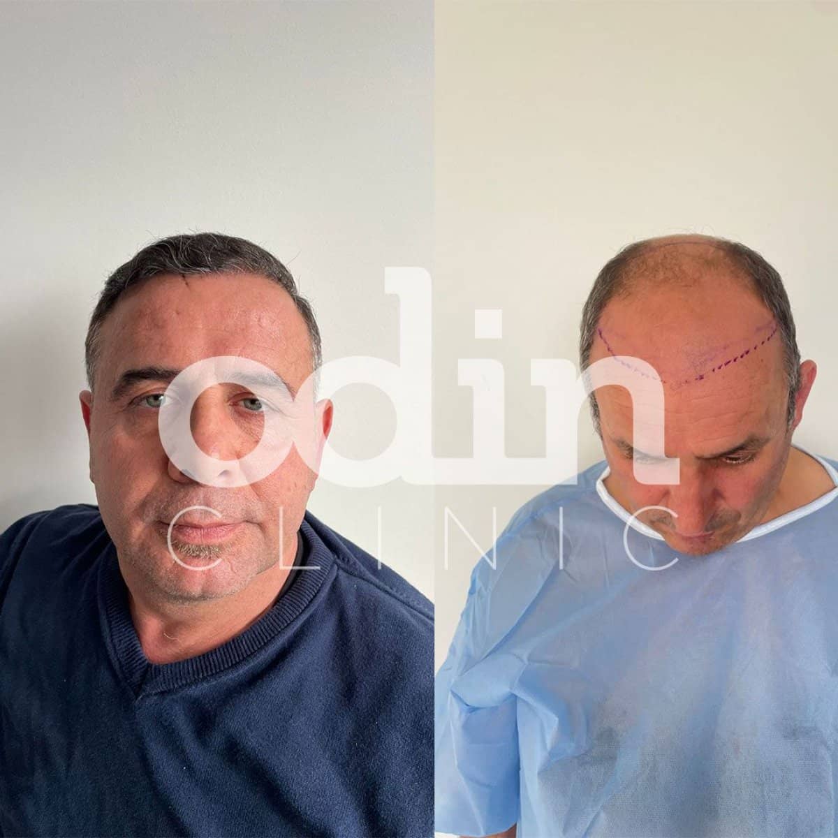 Case 19584 - FUE hair transplant