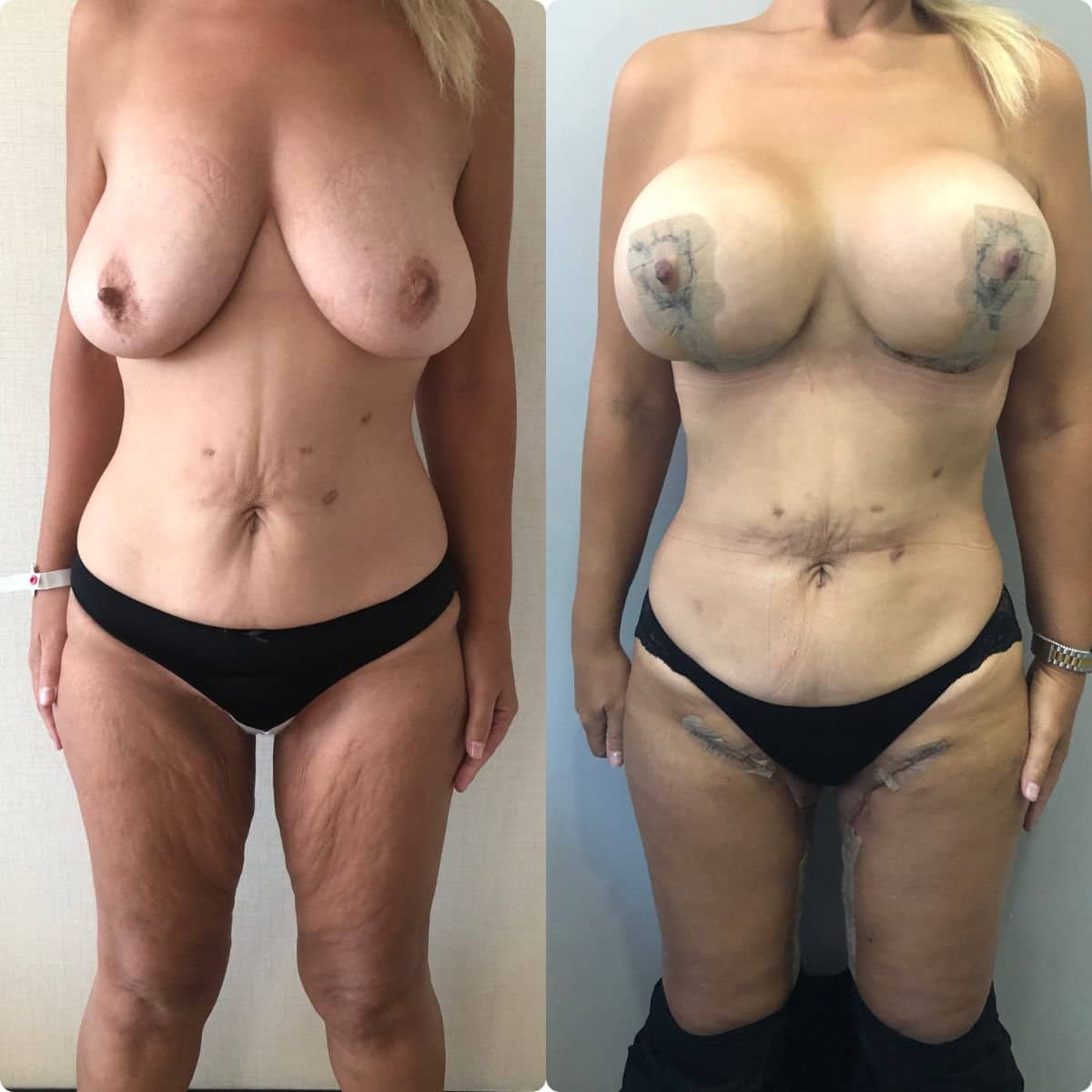 Case 19585 - breast lift