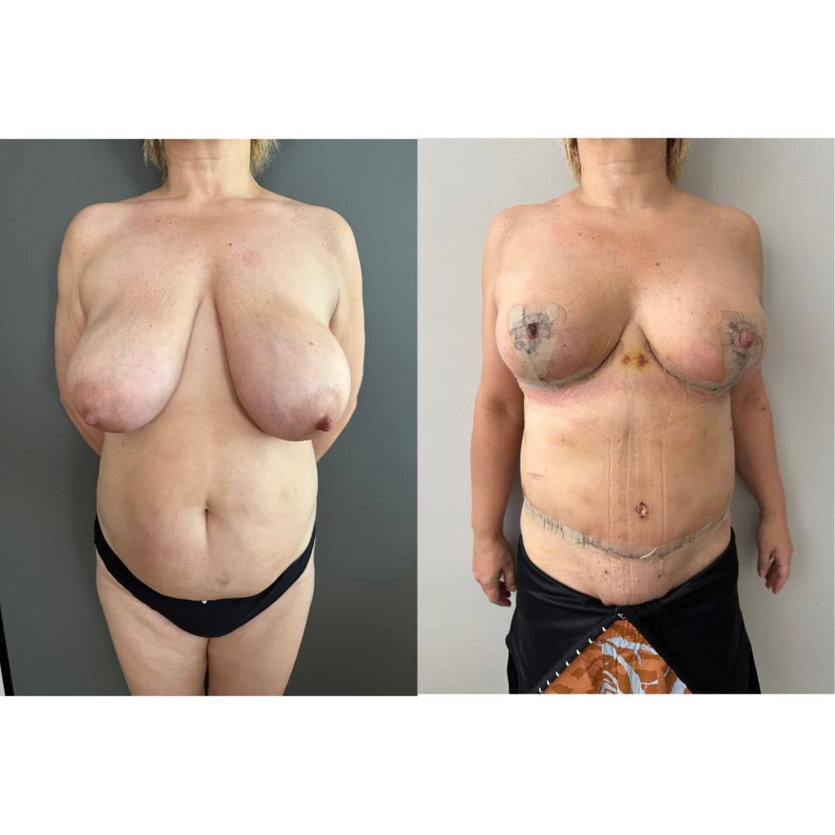 Case 19587 - mommy makeover